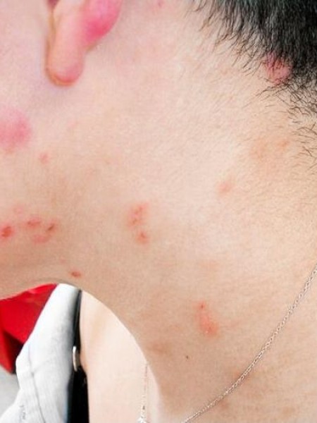 Избавиться от Постельных Клопов